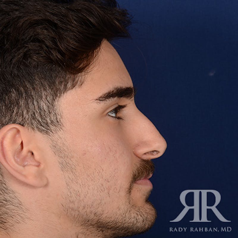 Male Rhinoplasty Before & After Gallery - Patient 103867 - Image 5