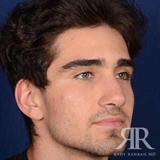Male Rhinoplasty Before & After Gallery - Patient 103867 - Image 4