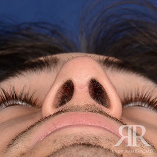 Male Rhinoplasty Before & After Gallery - Patient 103867 - Image 8