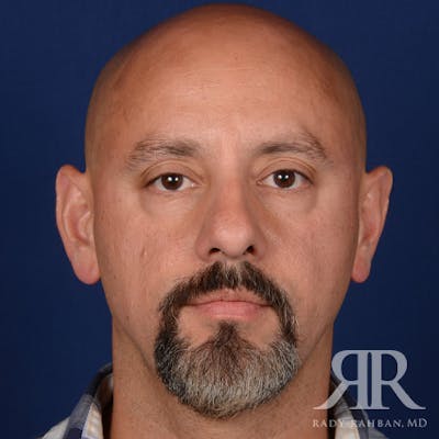 Male Rhinoplasty Before & After Gallery - Patient 226428 - Image 1
