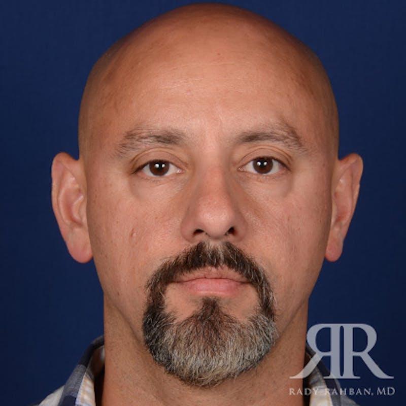 Male Rhinoplasty Before & After Gallery - Patient 226428 - Image 1