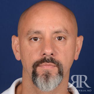 Male Rhinoplasty Before & After Gallery - Patient 226428 - Image 2