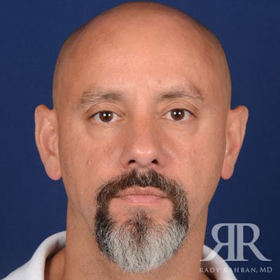 Male Rhinoplasty Before & After Gallery - Patient 226428 - Image 2