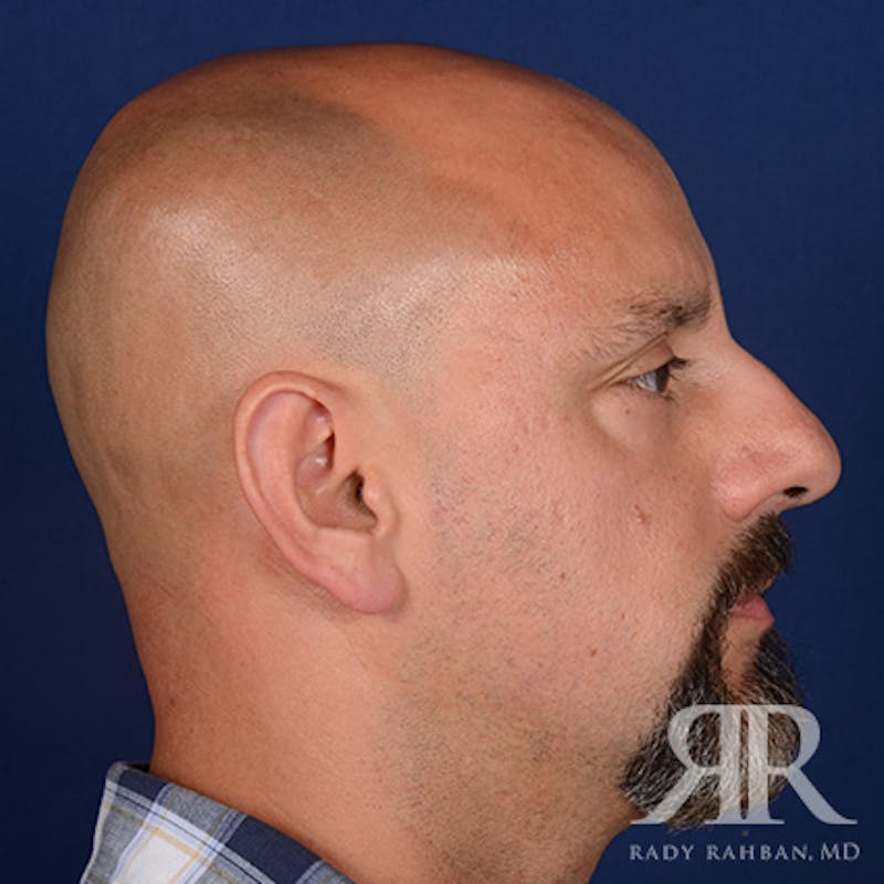 Male Rhinoplasty Before & After Gallery - Patient 226428 - Image 5