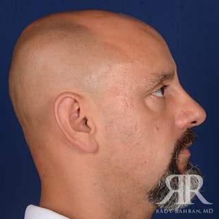 Male Rhinoplasty Before & After Gallery - Patient 226428 - Image 6