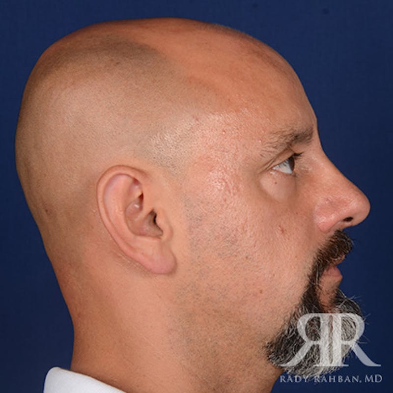 Male Rhinoplasty Before & After Gallery - Patient 226428 - Image 6