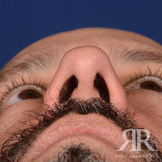 Male Rhinoplasty Before & After Gallery - Patient 226428 - Image 8