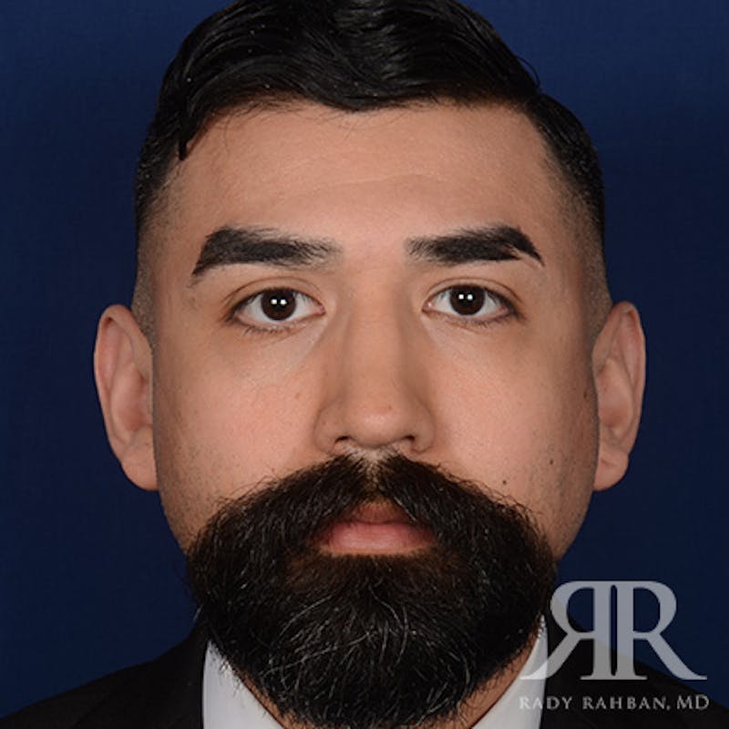 Male Rhinoplasty Before & After Gallery - Patient 262285 - Image 1