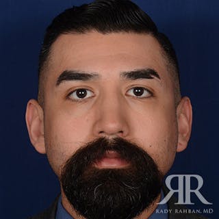 Male Rhinoplasty Before & After Gallery - Patient 262285 - Image 2