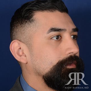 Male Rhinoplasty Before & After Gallery - Patient 262285 - Image 4
