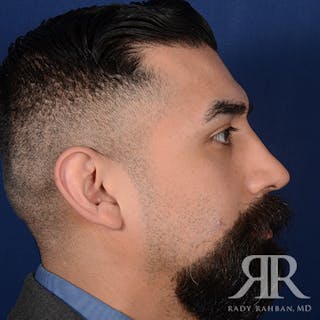 Male Rhinoplasty Before & After Gallery - Patient 262285 - Image 6