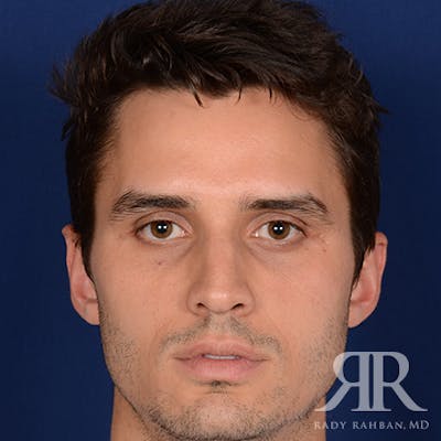 Male Rhinoplasty Before & After Gallery - Patient 289759 - Image 1