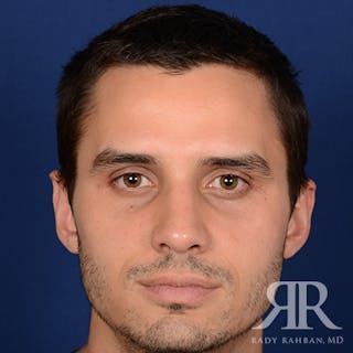 Male Rhinoplasty Before & After Gallery - Patient 289759 - Image 2
