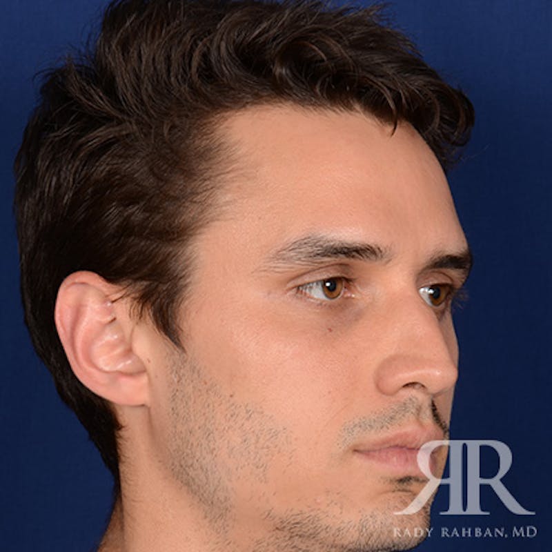 Male Rhinoplasty Before & After Gallery - Patient 289759 - Image 3