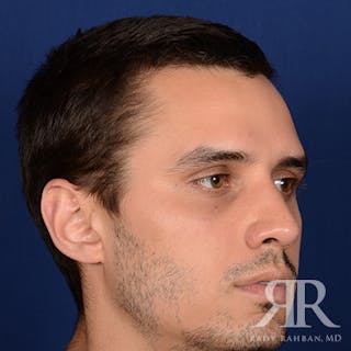 Male Rhinoplasty Before & After Gallery - Patient 289759 - Image 4