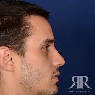 Male Rhinoplasty Before & After Gallery - Patient 289759 - Image 6