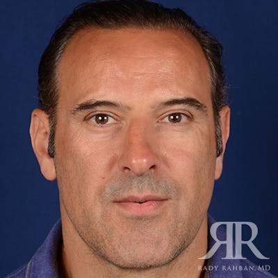Male Rhinoplasty Before & After Gallery - Patient 101198 - Image 1
