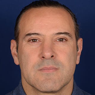 Male Rhinoplasty Before & After Gallery - Patient 101198 - Image 2