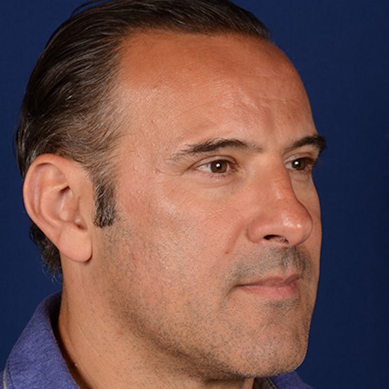 Male Rhinoplasty Before & After Gallery - Patient 101198 - Image 3
