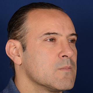 Male Rhinoplasty Before & After Gallery - Patient 101198 - Image 4