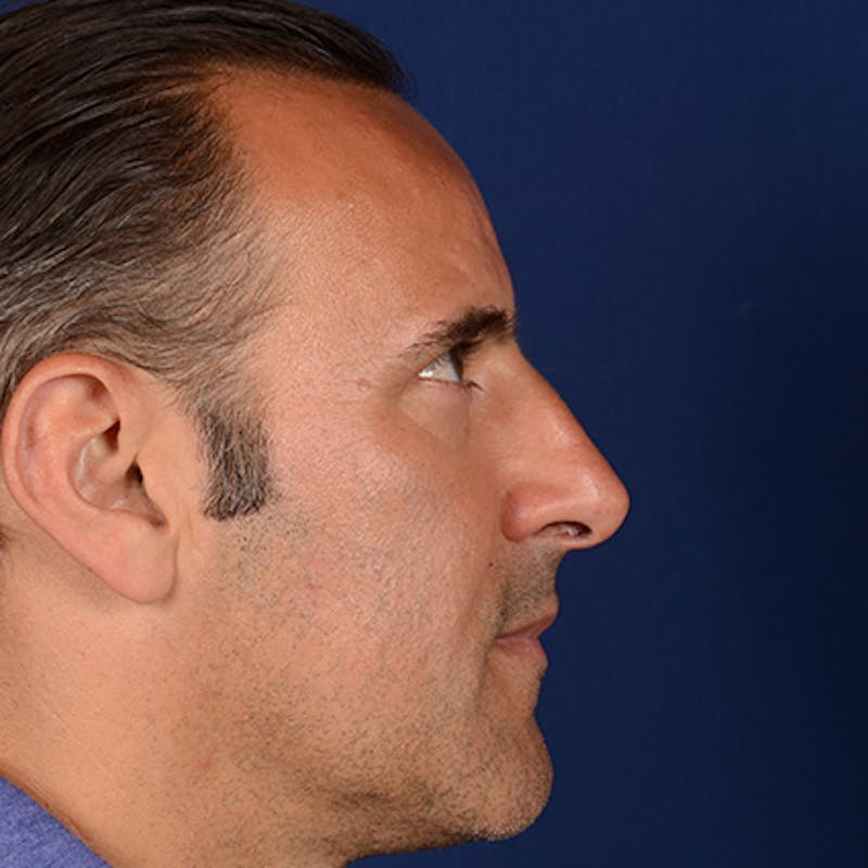 Male Rhinoplasty Before & After Gallery - Patient 101198 - Image 5