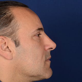 Male Rhinoplasty Before & After Gallery - Patient 101198 - Image 6