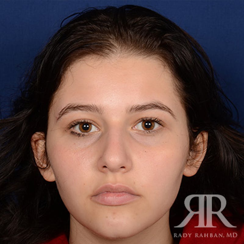 Female Rhinoplasty Before & After Gallery - Patient 163682 - Image 1