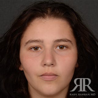 Female Rhinoplasty Before & After Gallery - Patient 163682 - Image 2