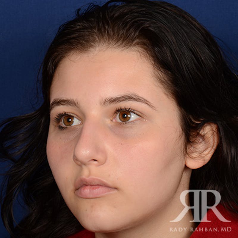 Female Rhinoplasty Before & After Gallery - Patient 163682 - Image 3
