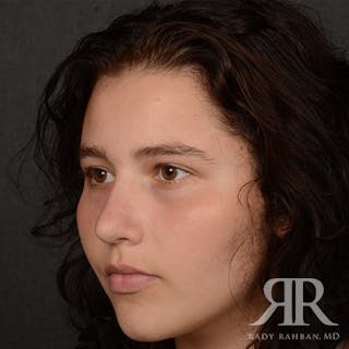 Female Rhinoplasty Before & After Gallery - Patient 163682 - Image 4