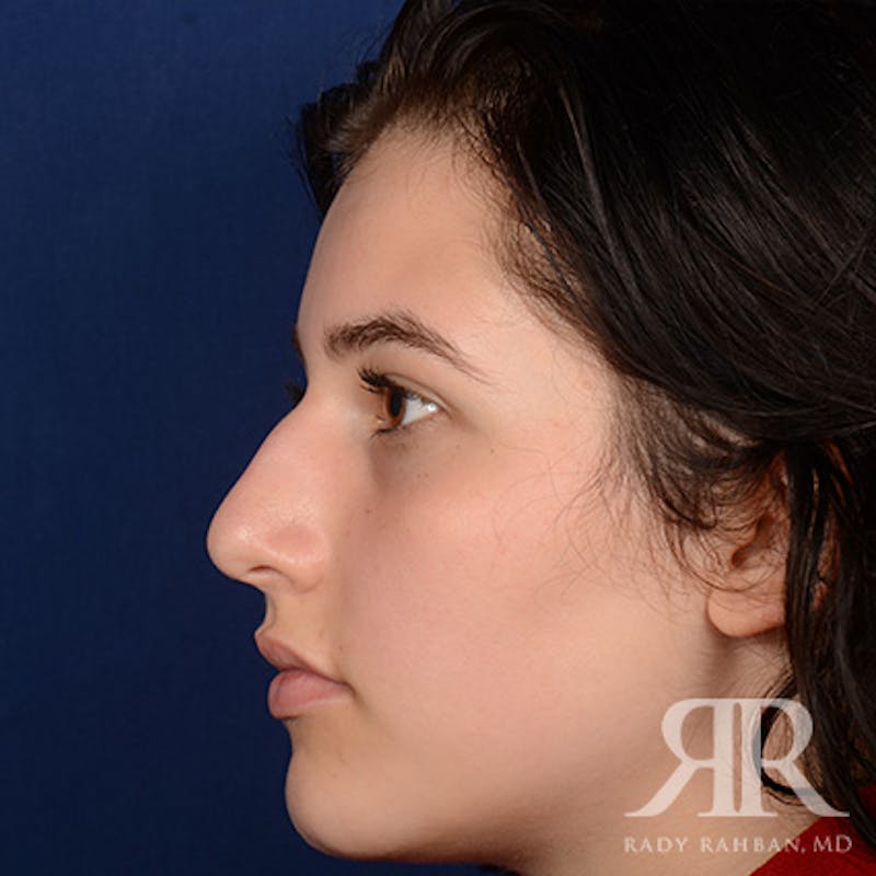 Female Rhinoplasty Before & After Gallery - Patient 163682 - Image 5