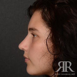 Female Rhinoplasty Before & After Gallery - Patient 163682 - Image 6