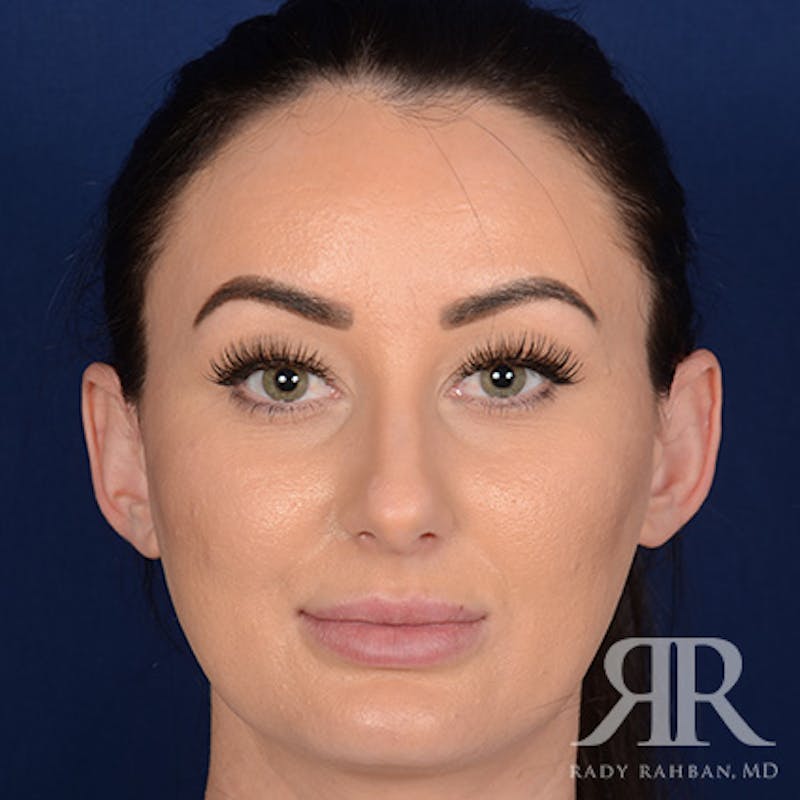Female Rhinoplasty Before & After Gallery - Patient 124772 - Image 1