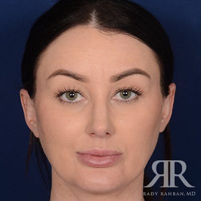 Female Rhinoplasty Before & After Gallery - Patient 124772 - Image 2