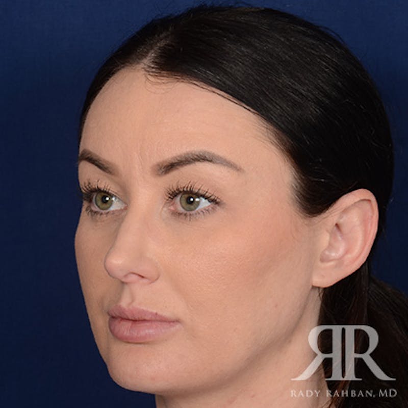Female Rhinoplasty Before & After Gallery - Patient 124772 - Image 4