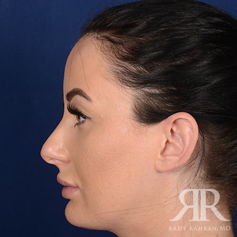 Female Rhinoplasty Before & After Gallery - Patient 124772 - Image 5