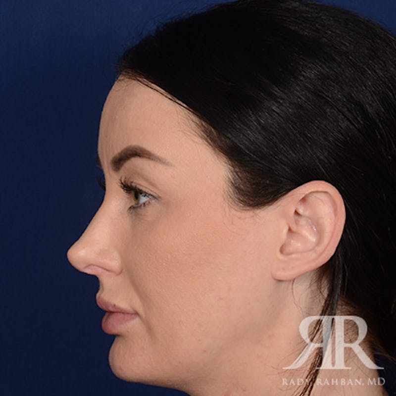 Female Rhinoplasty Before & After Gallery - Patient 124772 - Image 6