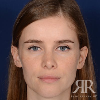 Corrective / Revision Rhinoplasty Before & After Gallery - Patient 104127 - Image 1