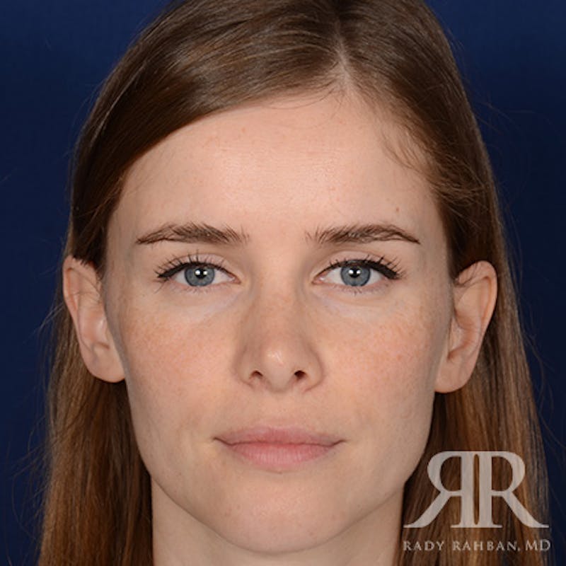 Corrective / Revision Rhinoplasty Before & After Gallery - Patient 104127 - Image 1