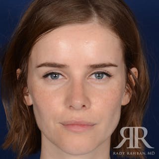 Corrective / Revision Rhinoplasty Before & After Gallery - Patient 104127 - Image 2
