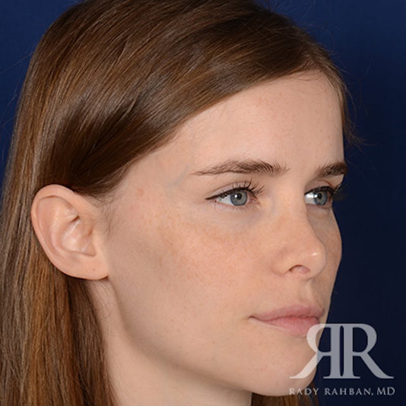 Corrective / Revision Rhinoplasty Before & After Gallery - Patient 104127 - Image 3