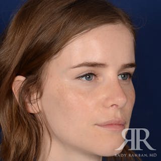 Corrective / Revision Rhinoplasty Before & After Gallery - Patient 104127 - Image 4