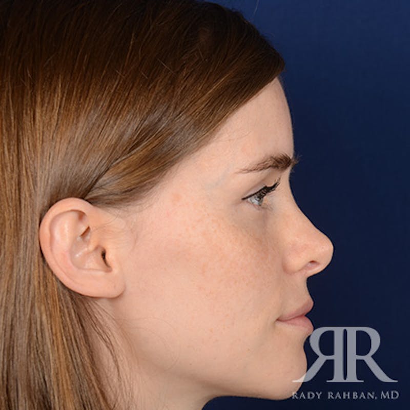 Corrective / Revision Rhinoplasty Before & After Gallery - Patient 104127 - Image 5