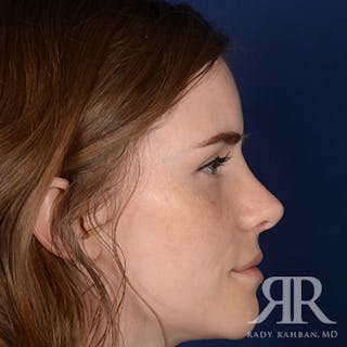Corrective / Revision Rhinoplasty Before & After Gallery - Patient 104127 - Image 6