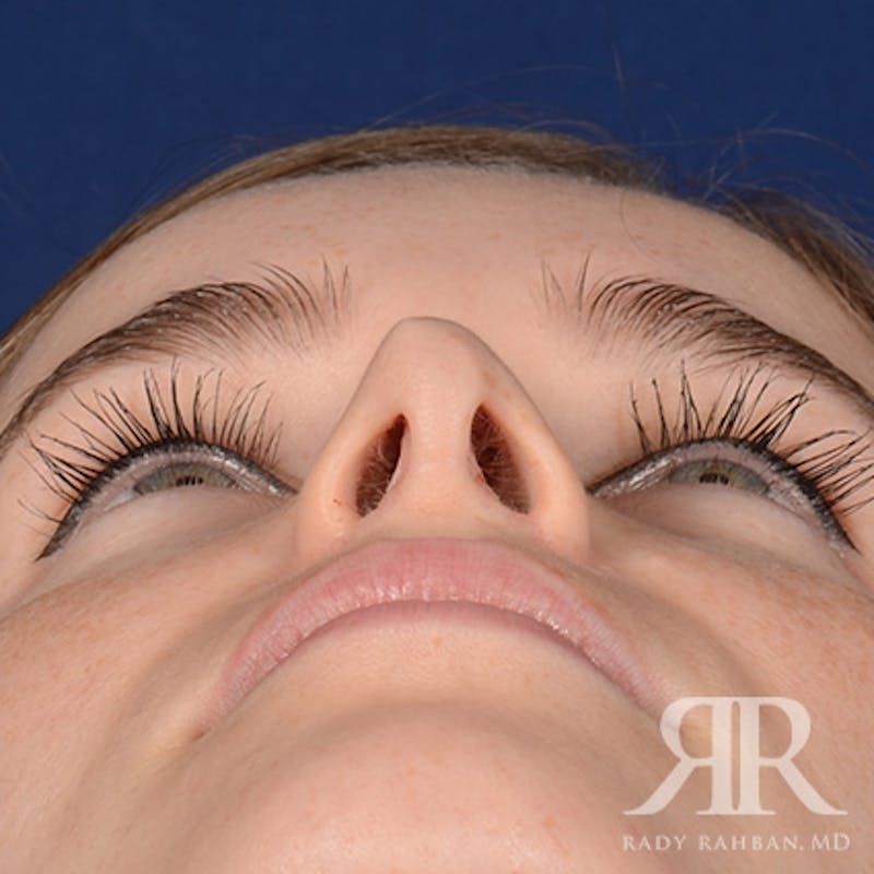 Corrective / Revision Rhinoplasty Before & After Gallery - Patient 104127 - Image 7