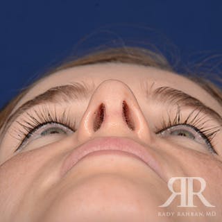 Corrective / Revision Rhinoplasty Before & After Gallery - Patient 104127 - Image 8