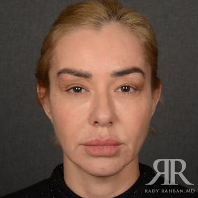 Facelift Before & After Gallery - Patient 399939 - Image 1