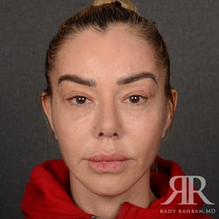 Facelift Before & After Gallery - Patient 399939 - Image 2