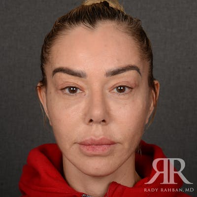 Facelift Before & After Gallery - Patient 399939 - Image 2