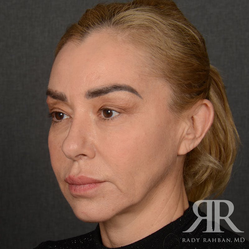 Facelift Before & After Gallery - Patient 399939 - Image 3